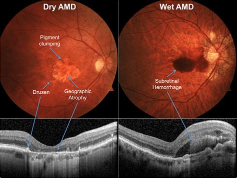 wet amd images.